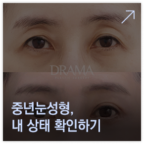 중년눈성형 상태확인