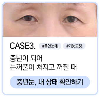 중년눈성형 상태확인