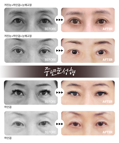 중년눈성형