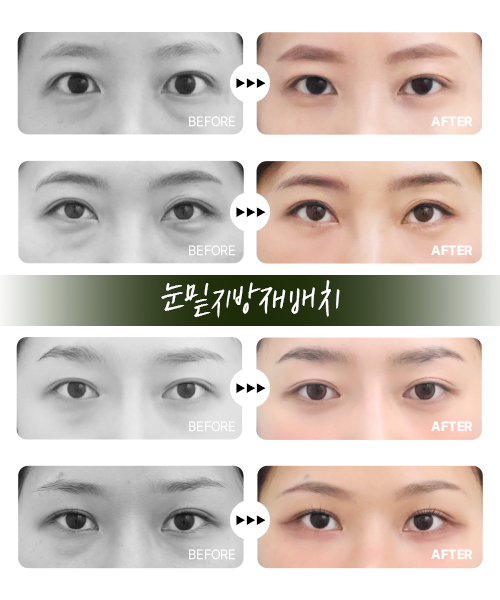 눈밑지방재배치